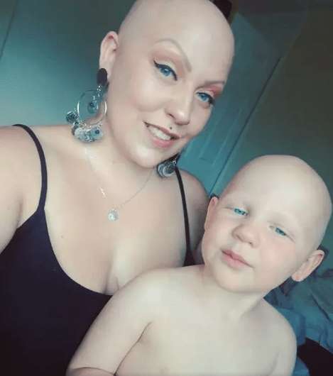 Ради дочери, которая тоже страдает алопецией, облысевшая мама решила не носить парик
